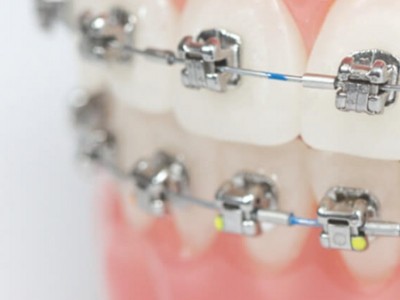 Ortodontia - Correção Ortodôntica com Sistema Damon®